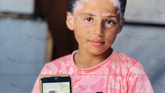 أطفال غزة... الخوف والفقد يخلفان أمراضاً جسدية ونفسية