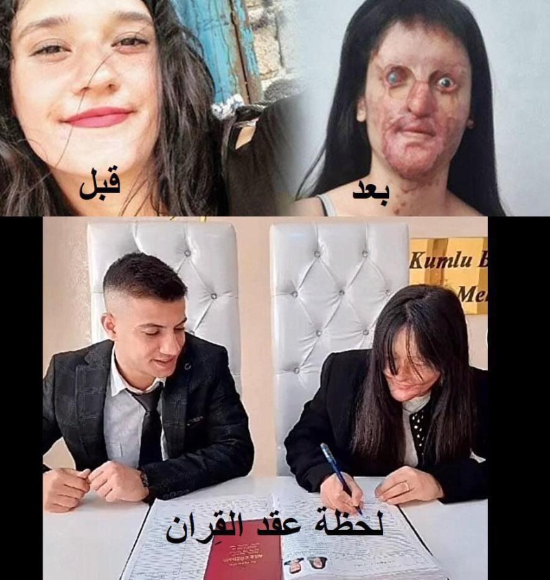 تسبب في تشوه وجهها فتزوجته!